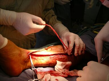 Chirurgie venă