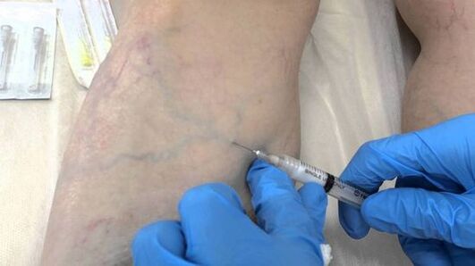 scleroterapie pentru vene varicoase de pe picioare la femei