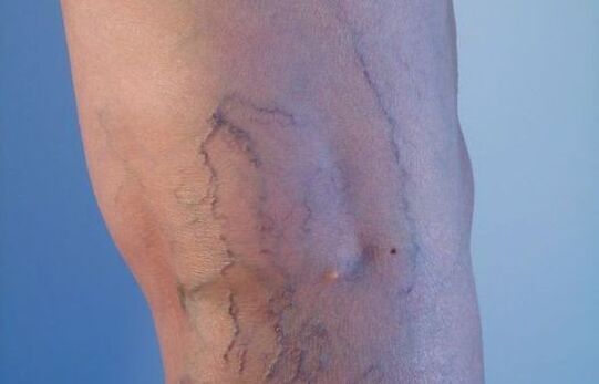 vene varicoase pe picioare la femei