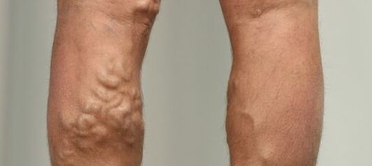 vene varicoase pe picior