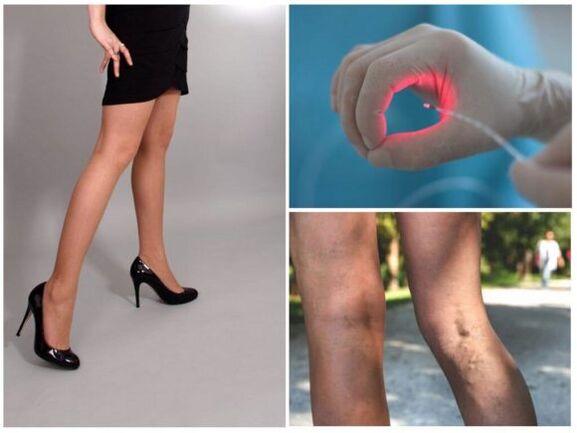 Tratamentul cu laser al venelor varicoase de pe picioare